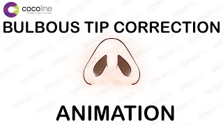 Bulbous Tip Correction: 90-Second Nose Transformation Guide - Rhinopla