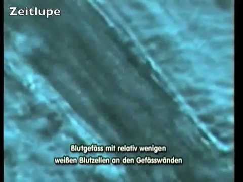 Unblutige Chirurgie des Prostata-Adenom Behandlung von Prostatitis prostanorm Preis