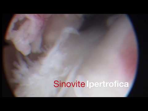 Sul costo intervento chirurgico ai legamenti del ginocchio Vertebre della chirurgia spinale cervicale