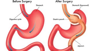 Life After Gastric Bypass: My Transformation Story #viral