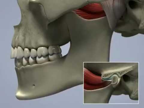 Farmaci per il trattamento delle articolazioni Artra Miele massaggio con osteocondrosi