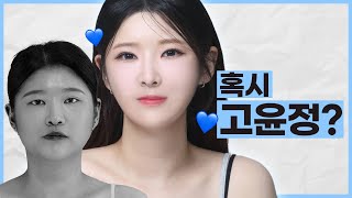 저보고 3초 고윤정이래요 2편 (수술 후) ㅣ성형비포에프터 ㅣ 뷰티라인성형외과