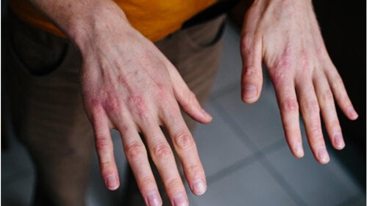 Watch Manos agrietadas por el frío: ¿cómo tratarlas | Maha TV Now Manos agrietadas por el frío: ¿cómo tratarlas | Maha TV