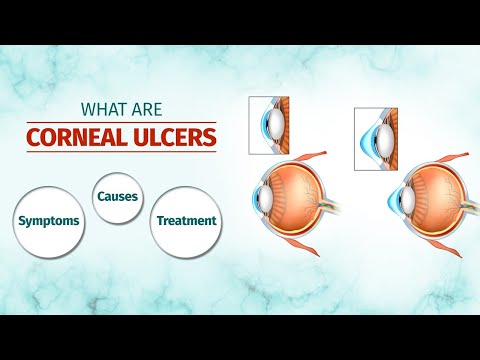 What are Corneal Ulcers? Symptoms, Causes, Treatment Options and More