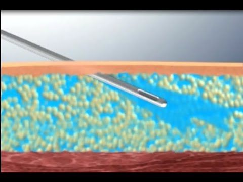 What is Liposuction and How Does it Work