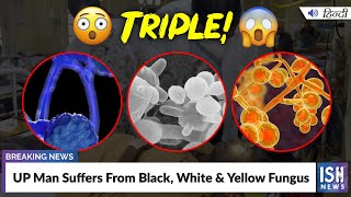 UP Man Suffers From Black, White & Yellow Fungus