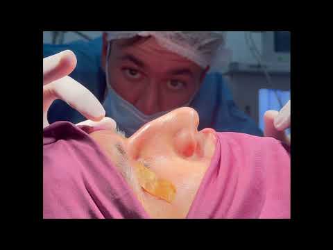 Rinoplastika — Dr. Choriyev #1