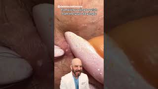 Removing a year old pimple patch👀 (credit:delarouxskincare on TT) #pimple #satisfying #dermatology