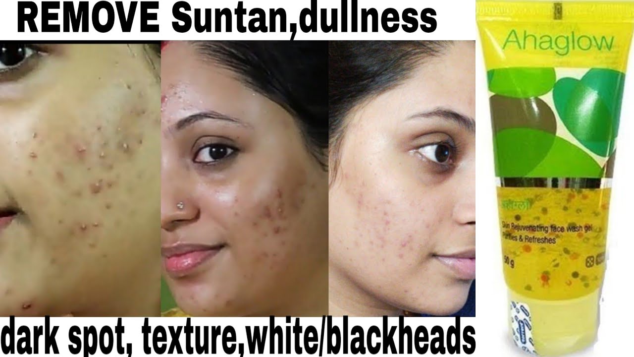 How I cleared acne in 4 months || Doctor recommended AHAGLOW ADVANCE FACE WASH for acne,dark spots |