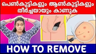 How to remove body & butt acne scars🙄കുഞ്ഞി കുരുക്കൾ കാരണവും പരിഹാരവും💯|Body Hygiene tips💯