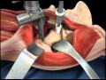 Direct Anterior Approach Hip Replacement