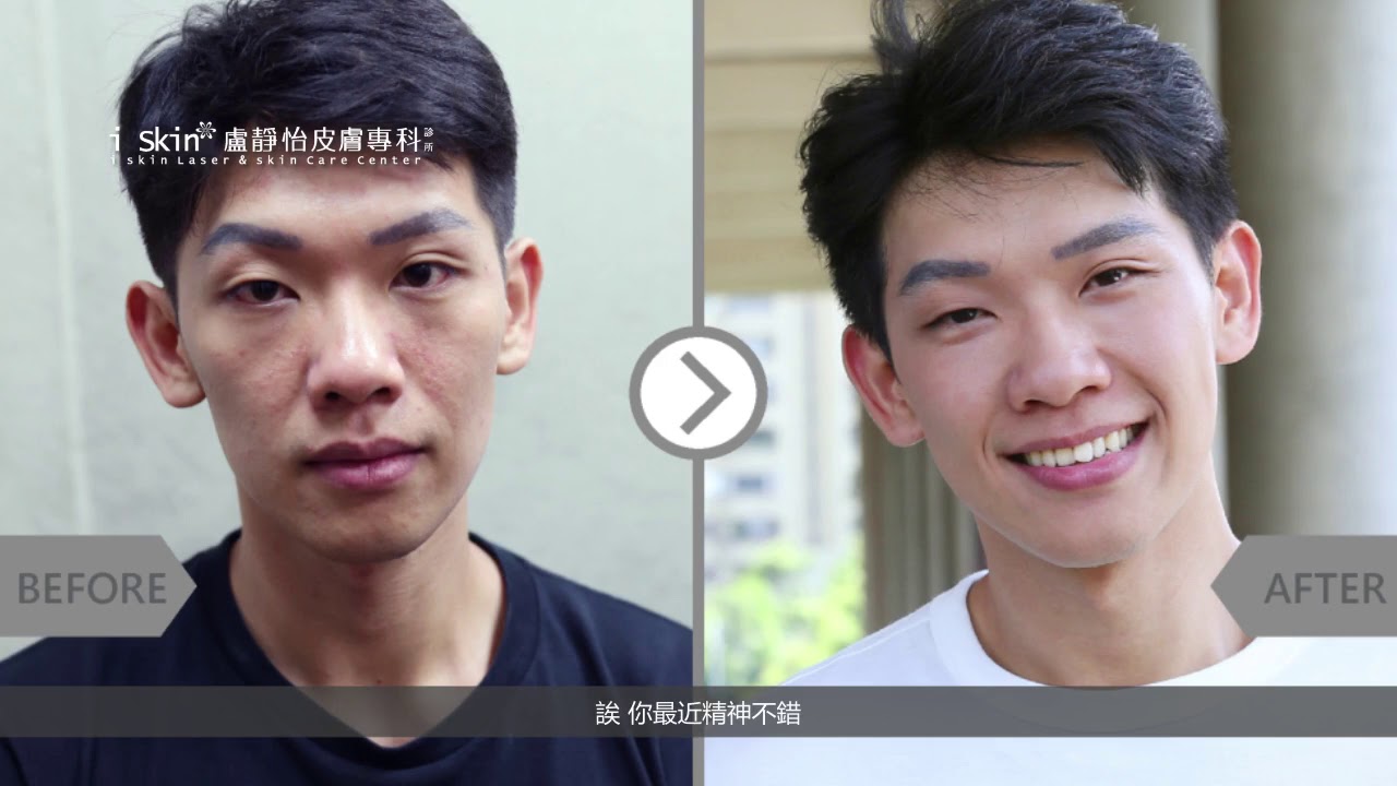 iSkin 盧靜怡皮膚專科診所【玻尿酸】小鮮肉進化中_Kelvin