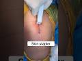 Skin Stapler किस लिए Use होता है What Is A Skin Stapler Used For Shortsindia