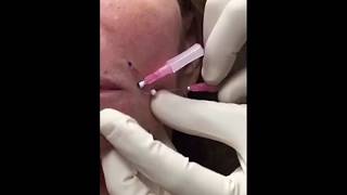 Lace Lift to the corner mouth and smile lines