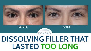 Dissolving Filler that Lasted Too Long