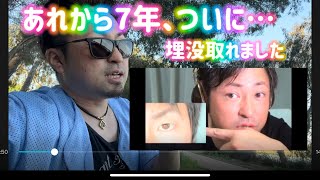 二重の整形から7年で…#美容整形 #埋没方 #整形外科