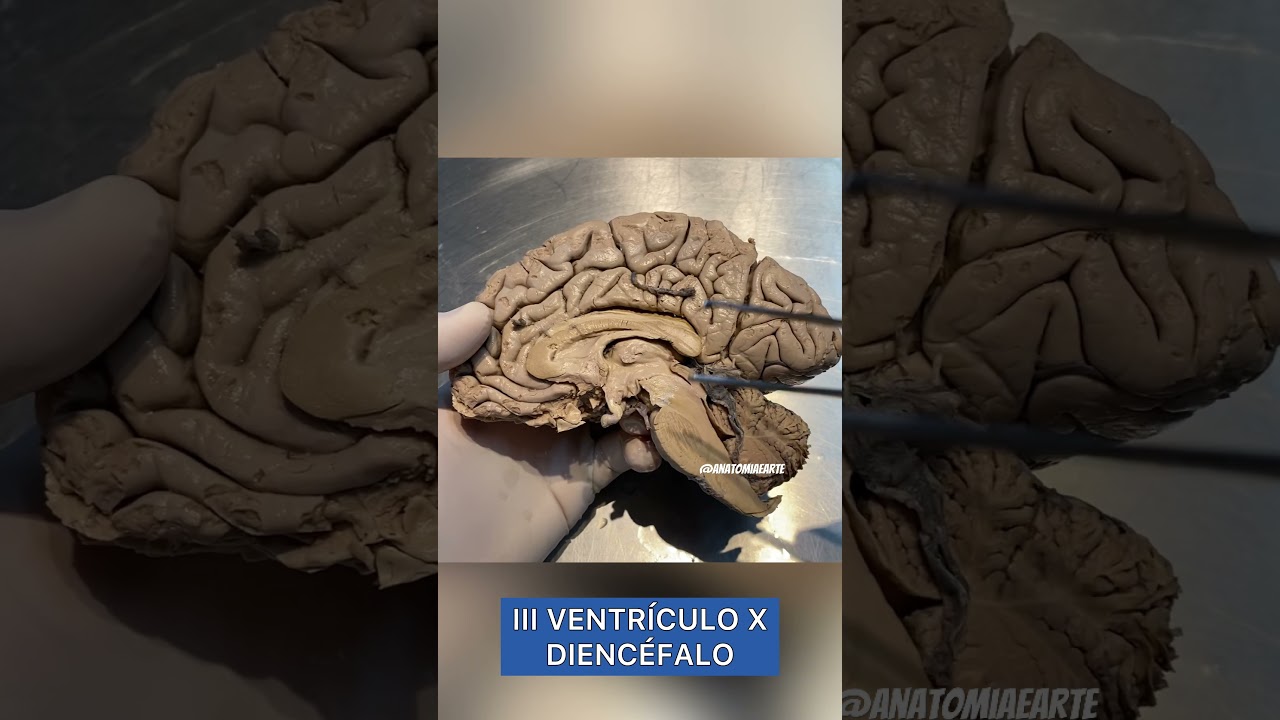 Qual a relação do III Ventrículo e o Diencéfalo? 👀🧠 #anatomy #anatomiapratica #neuroscience