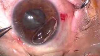 Cataract Extraction with Iridodialysis Repair