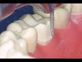 Full Gold Crown in 7 Steps | Technique for Preparing the FGC on A Mandibular Molar