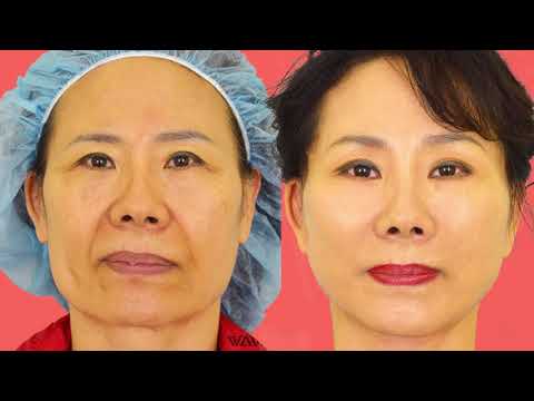 KJ Gets a FACELIFT at WAVE Plastic Surgery! (AMAZING)