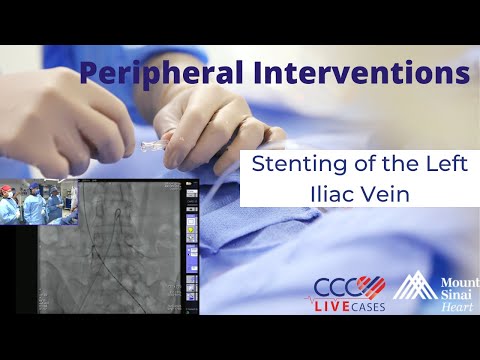 Stenting of the Left Iliac Vein - September 24, 2014 Live Case Video