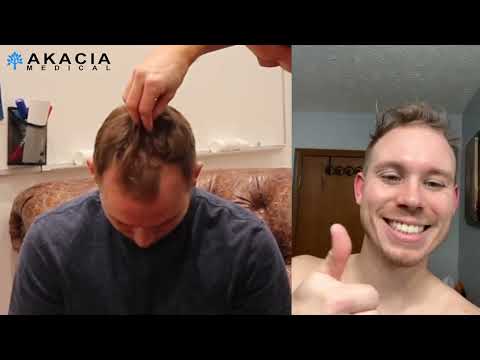 American goes to Sweden for hair transplant