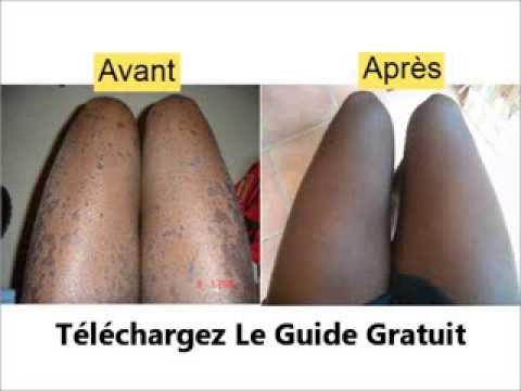 comment guerir le psoriasis naturellement