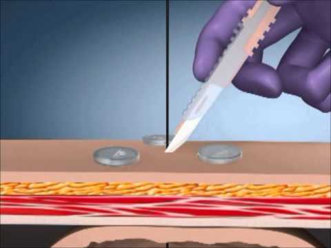 MIC Introducer Kit: Sistema di posizionamento percutaneo