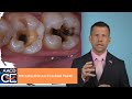 Introduction to Cracked Teeth