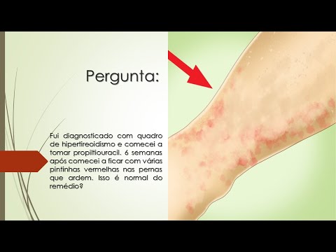 Tenho Hipertireoidismo e tomo Propiltiouracil | Apareceram pintas vermelhas que coçam | É normal?