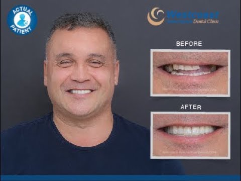 Achieving the Perfect Smile with 6 Implants and 26 Crowns | Westcoast Dental Clinic