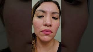 #biooil #acne #scars          first week with using biooil.