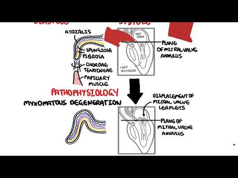 Le prolapsus vulvulaire mitral 