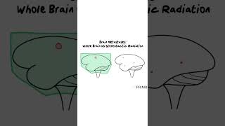 For patients with #brainmets who don&#39;t undergo surgery, radiation therapy is the main treatment.