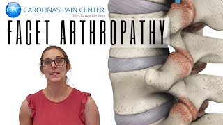 Natalie Explains Facet Arthropathy