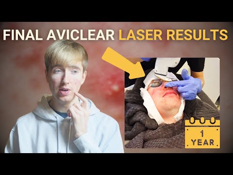 AviClear Acne Laser 1 Year Results - Honest Review & Before/After Results for Cystic Acne