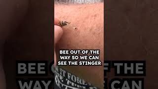 How to Remove Bee Sting