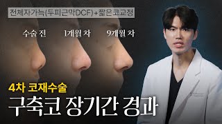4차 코재수술 구축코 장기간 경과 [늑떼선생김현주의 수술사례 및 케이스리뷰]