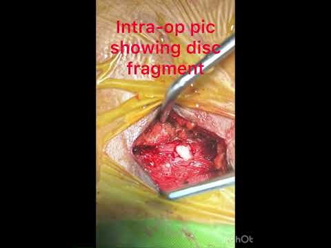 Lumbar Microscopic Discectomy | Dr.Sudheer Pothu 