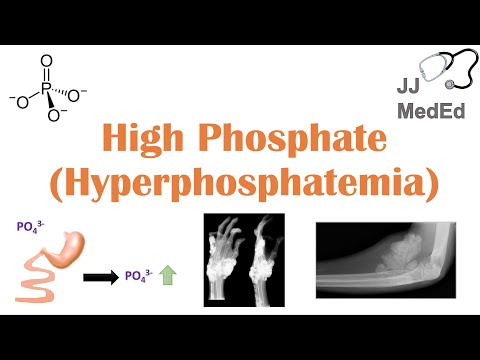 High Phosphate (Hyperphosphatemia): Dietary Sources, Causes, Symptoms, Treatment