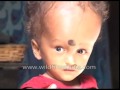 Indian Child S Head Suddenly Starts Growing Weighs 8 Kilograms
