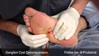 Ganglion Cyst Pop Plantar Aspect Of Foot