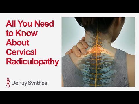 Cervical Radiculopathy (Pinched Nerve in Neck): Causes, Symptoms & Treatment Options | DePuy Synthes
