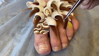 Hit foot on the bed and brought the parasites under the skin - parasites removal
