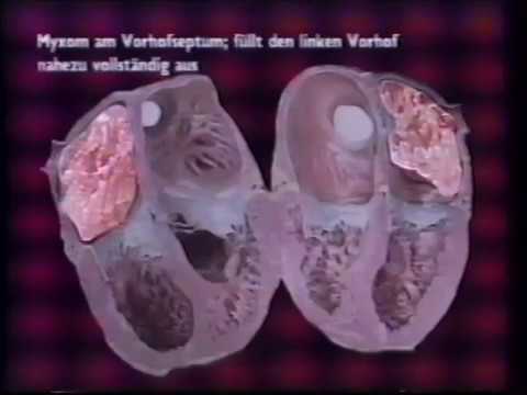 Herz Kreislauf Pathologie Herztumore