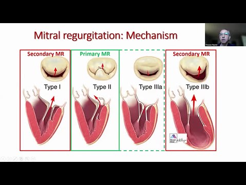 TCHVG 2024 | Mitral Valve Session I