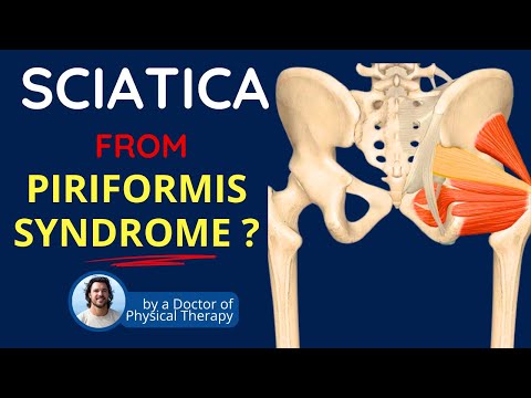 Piriformis Syndrome, Sciatica Symptoms & Back Pain