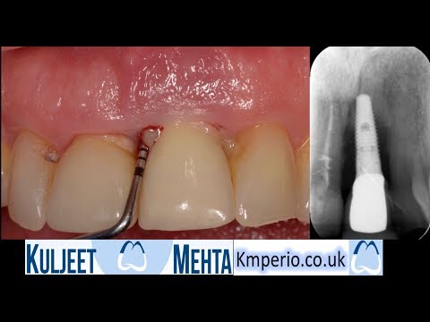 Removal of Failed Dental Implant
