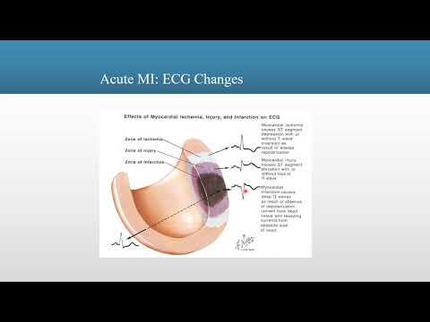 12_Lead EKG : Understanding Ischemia, Injury and Infarctions