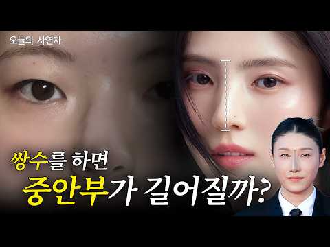 중안부가 길어질까 봐 쌍꺼풀 수술이 고민돼요. · 韩语